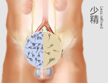 什么是少精症?少精症有什么症状?