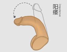 男人阳痿的症状主要是哪些?