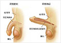 男性勃起障碍如何治疗